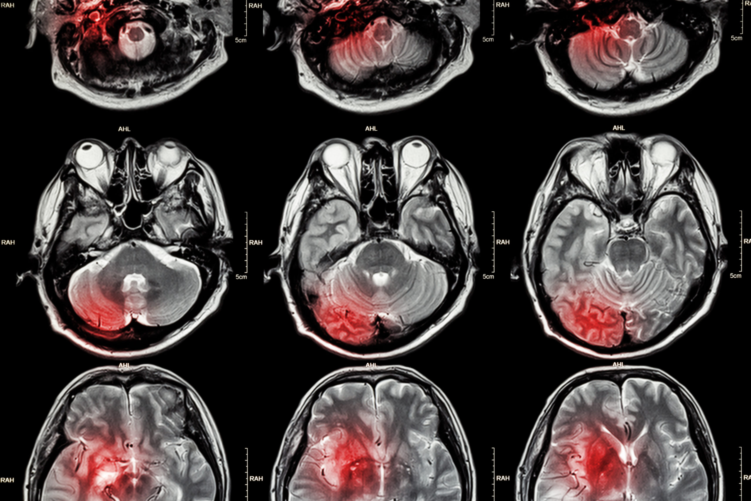 Film MRI ( Magnetic resonance imaging ) of brain ( stroke , brain tumor , cerebral infarction , intracerebral hemorrhage ) ( Medical , Health care , Science Background ) ( Cross section of brain )